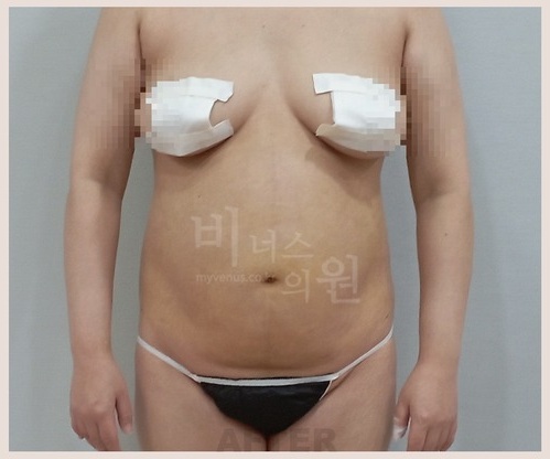 복부 지방흡입 수술 후 1주 정면 비교