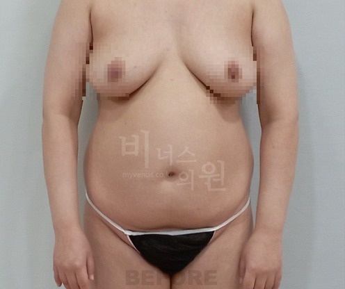 복부 지방흡입 수술 전 정면 체형