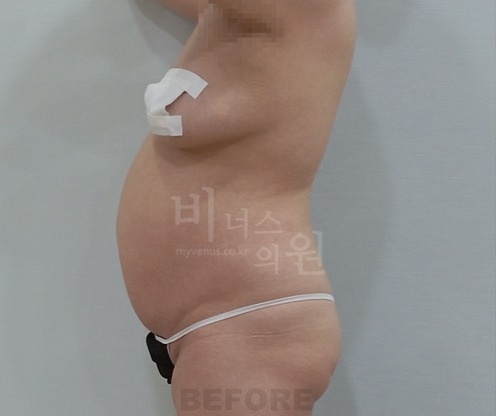 복부 지방흡입 수술 전 우측면 체형