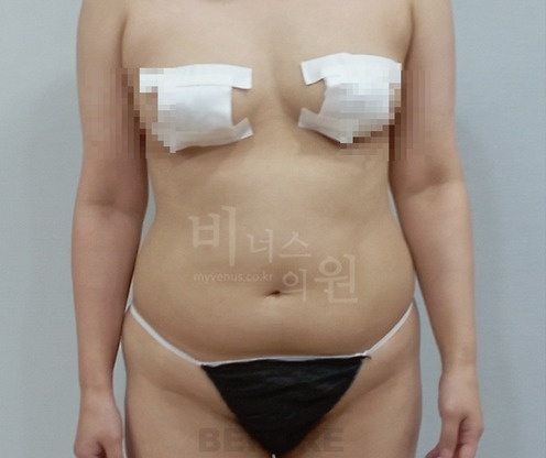 복부 지방흡입 수술 전 정면