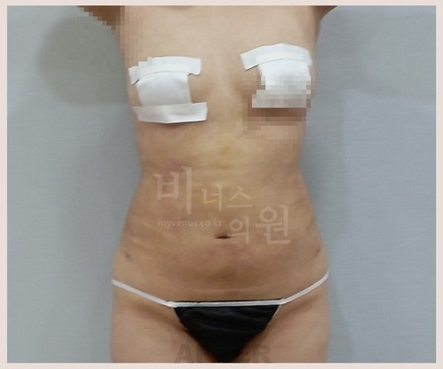 복부 지방흡입 수술 후 정면B
