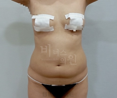 복부 지방흡입 수술 전 정면B