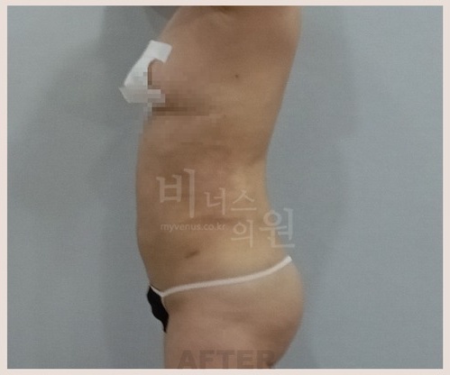 복부 지방흡입 수술 후 우측면