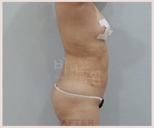 복부 지방흡입 수술 후 좌측면