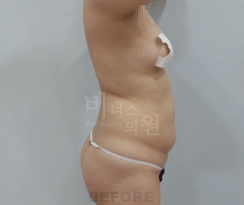 복부 지방흡입 수술 전 좌측면