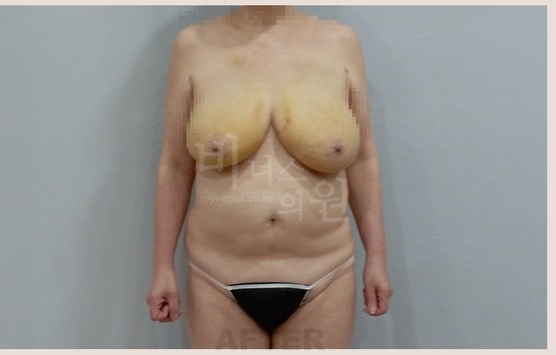 처진 가슴, 절개 없이 지방흡입으로 리프팅할 수 있을까?