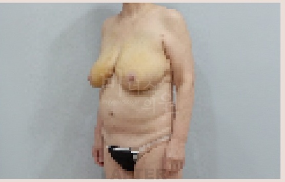 유방하수 교정 지방흡입 수술 후 45도