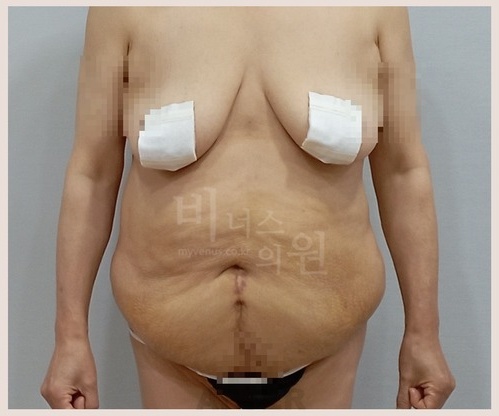 상하복부 지방흡입 수술 후 1주 정면 체형