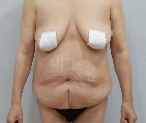 상하복부 지방흡입 수술 전 정면 체형