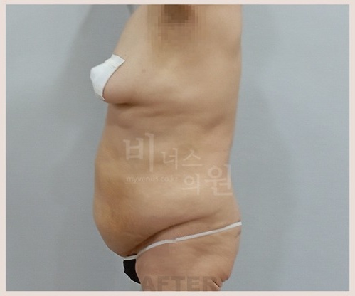 상하복부 지방흡입 수술 후 1주 우측면 체형