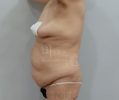 상하복부 지방흡입 수술 전 우측면 체형