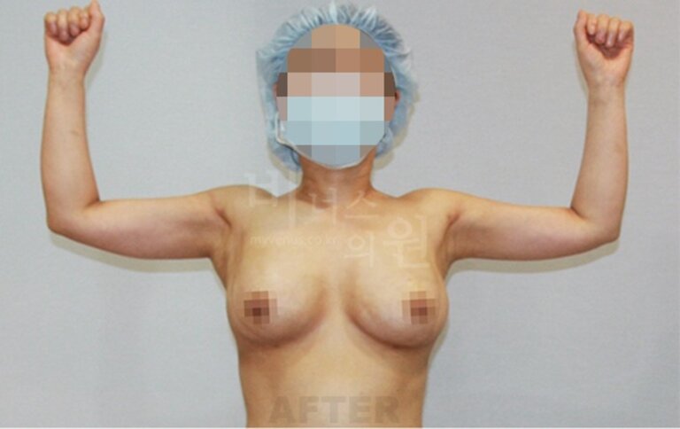 팔지방흡입 비용, 어떻게 결정될까요? 수술 범위와 선택 가이드