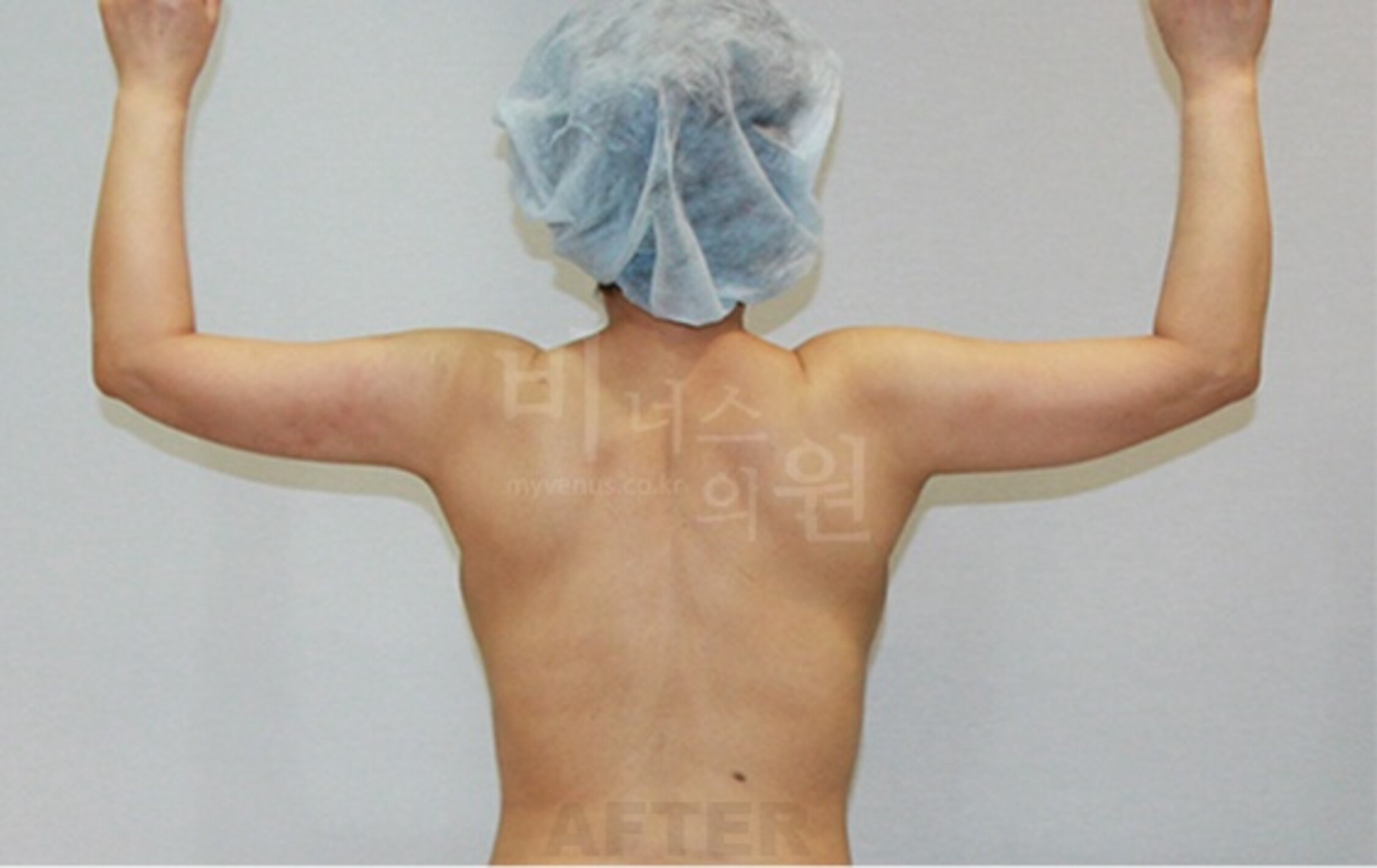 팔 맥시머C 지방흡입 수술 후 후면