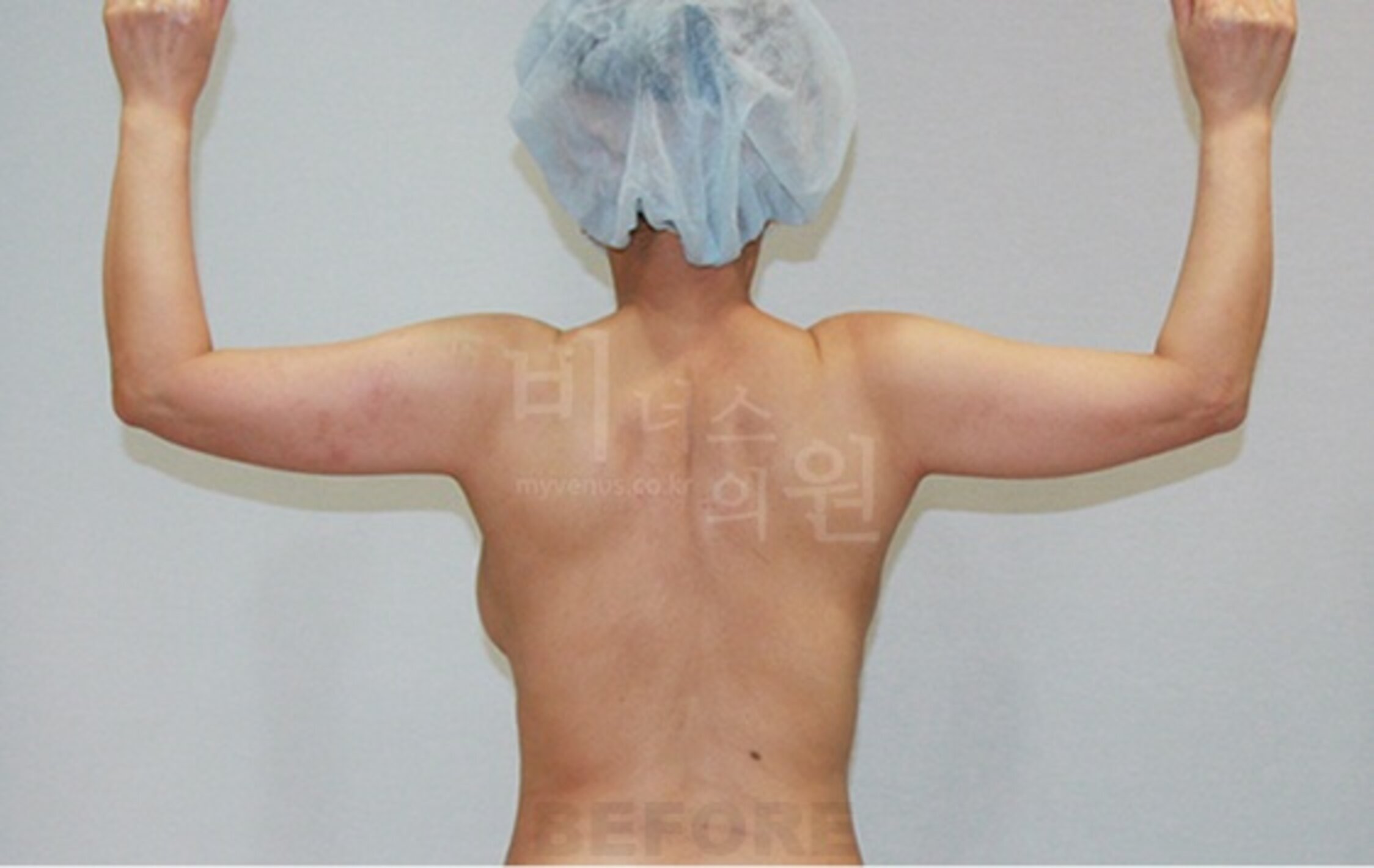 팔 맥시머C 지방흡입 수술 전 후면