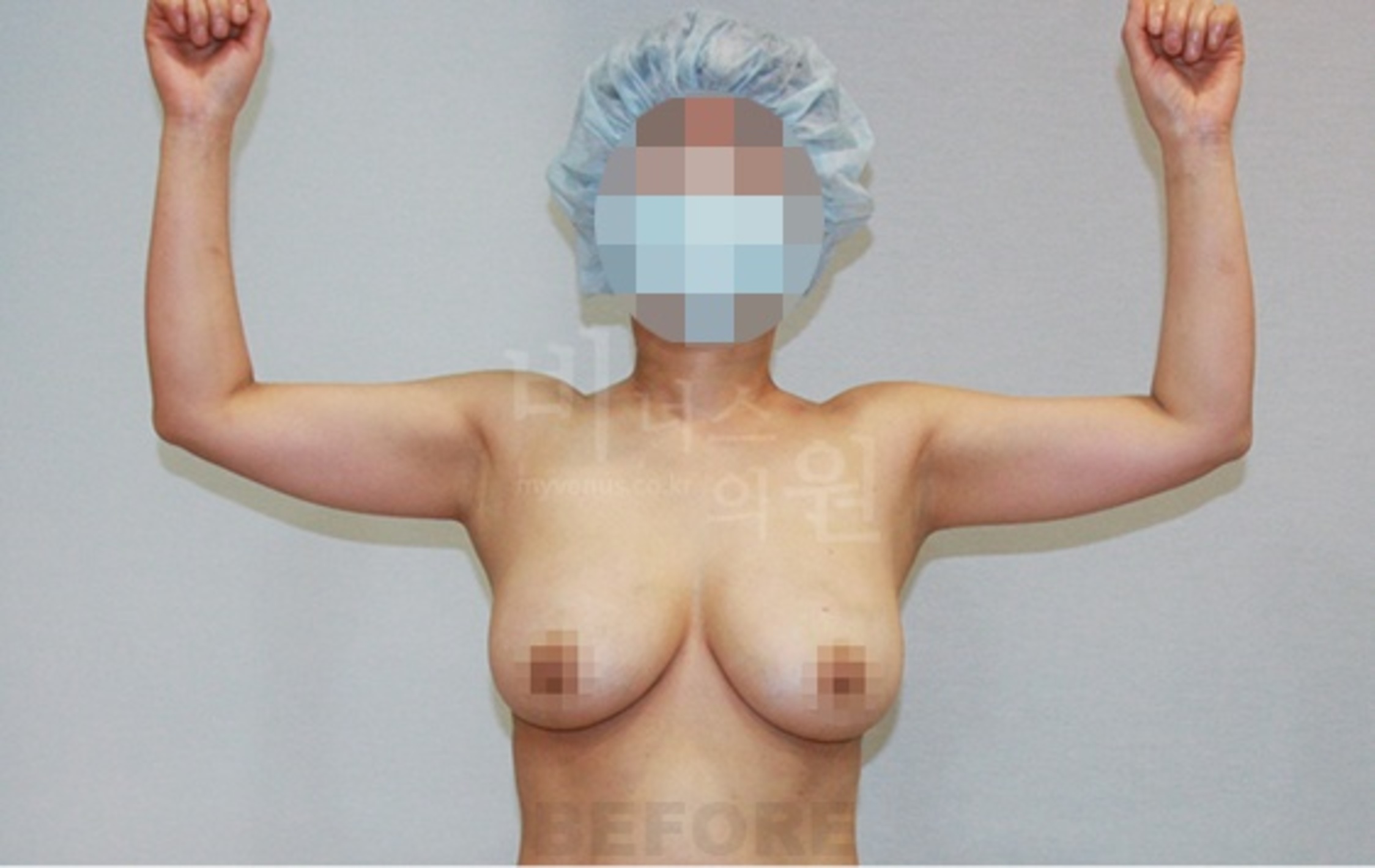 팔 맥시머C 지방흡입 수술 전 정면