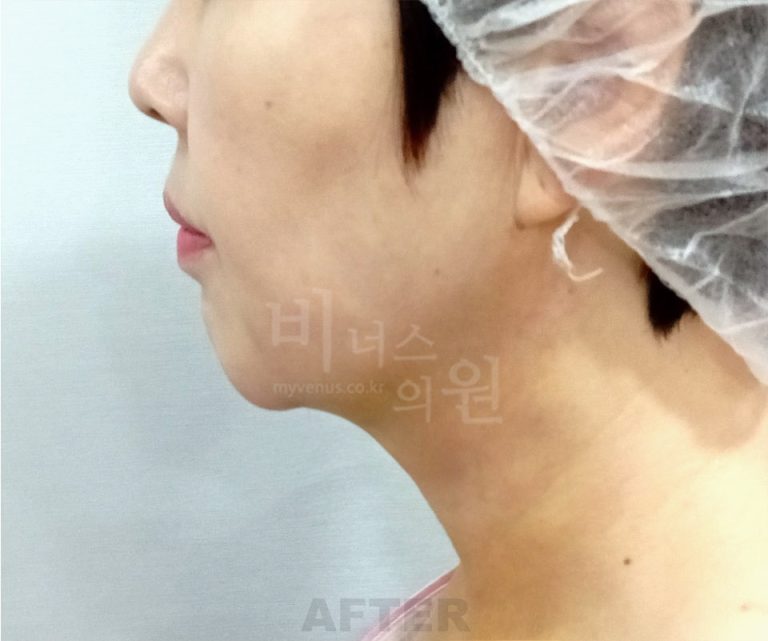 이중턱 지방흡입 비용, 어떻게 결정될까요? 선택 전 꼭 확인할 것들