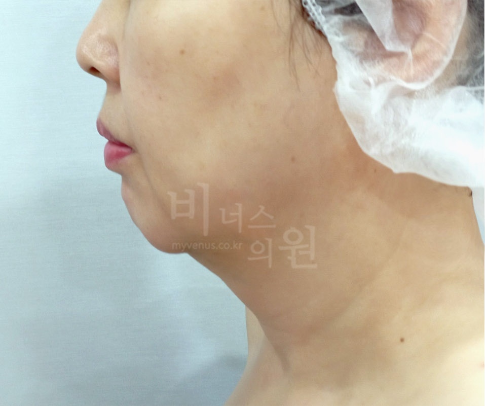 이중턱 지방흡입 전후사진 측면 수술 전 — 이중턱이 두드러지고 목과 턱의 경계가 불명확한 상태