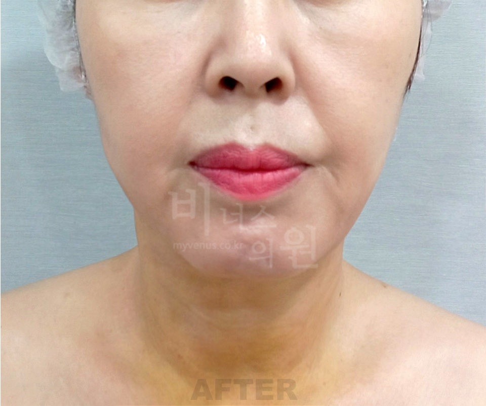 이중턱 지방흡입 전후사진 정면 수술 후 — 턱선이 정리된 상태