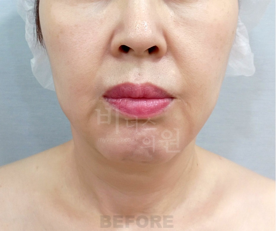 이중턱 지방흡입 전후사진 정면 수술 전 — 턱밑 지방이 두드러진 상태