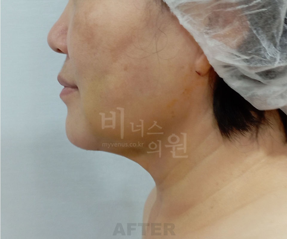 이중턱 지방흡입 CASE2 측면 수술 후 — 턱선에서 목으로 이어지는 라인이 깔끔해진 상태