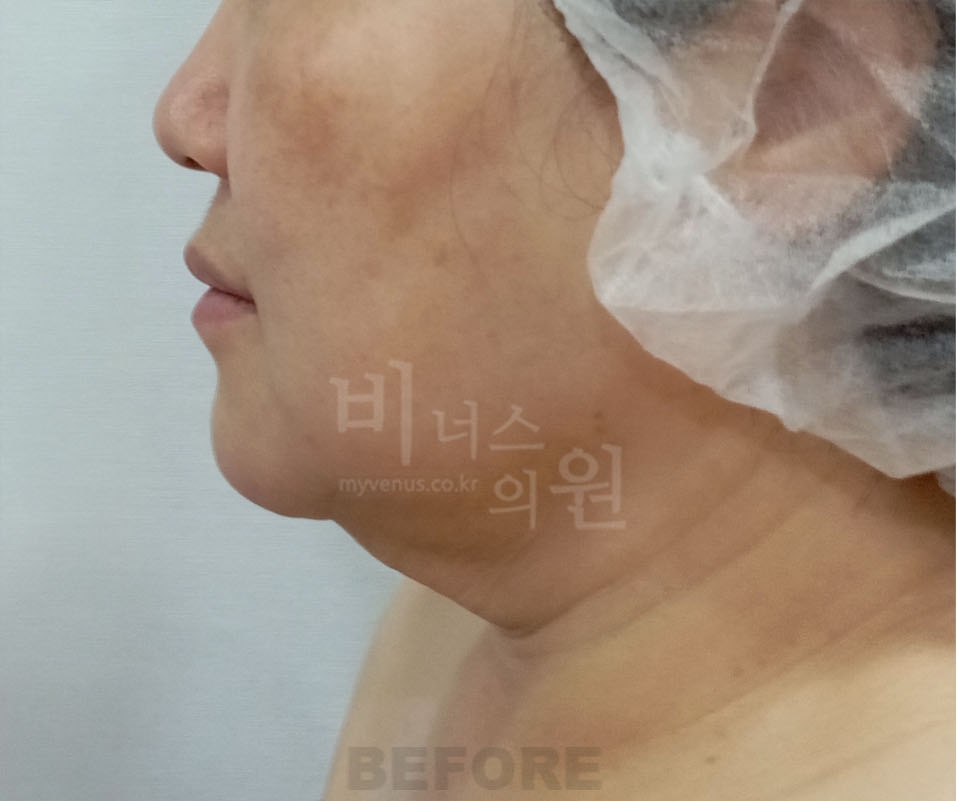 이중턱 지방흡입 CASE2 측면 수술 전 — 턱밑에서 목으로 이어지는 지방이 두꺼운 상태