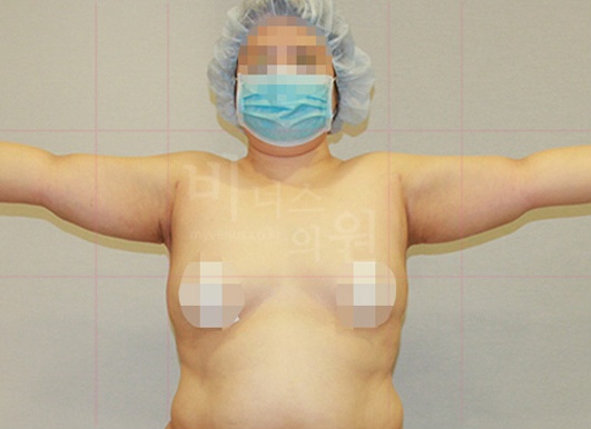 팔뚝지방흡입 대용량 수술 후 후면