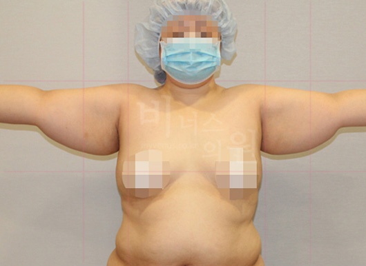 팔뚝지방흡입 대용량 수술 전 후면
