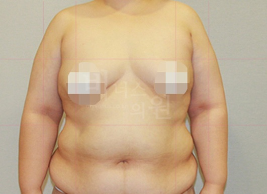 팔뚝지방흡입 대용량 수술 후 정면