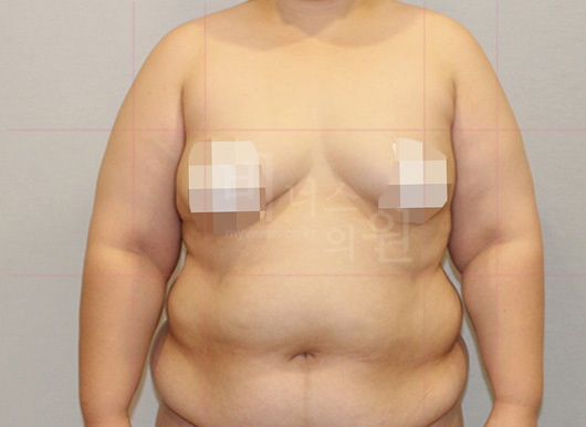 팔뚝지방흡입 대용량 수술 전 정면