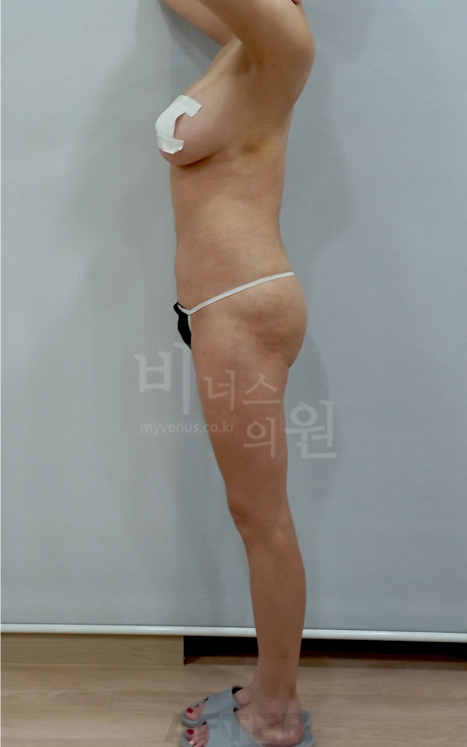 엉덩이하방 복합 지방흡입 수술 후 측면 1주일