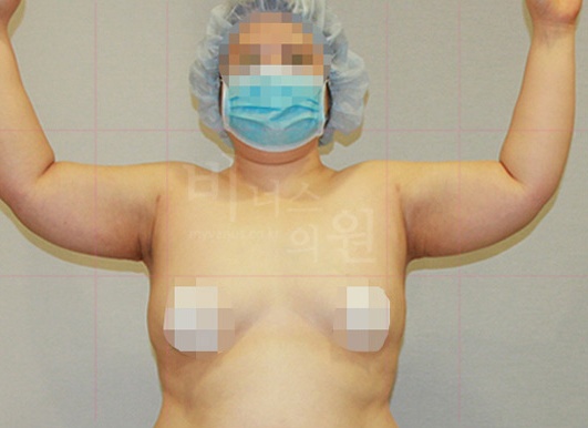 팔뚝지방흡입 대용량 수술 후 측면