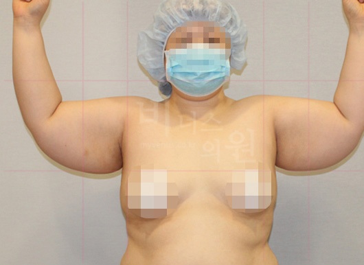 팔뚝지방흡입 대용량 수술 전 측면