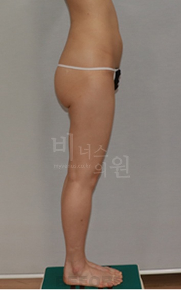 엉덩이축소 지방흡입 수술 전 우측면 하체 라인