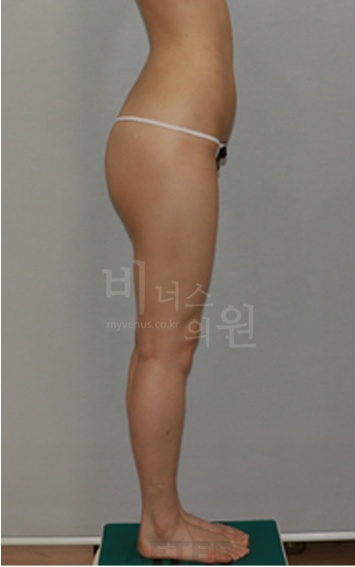 엉덩이지방흡입 선택 가이드 — 내 체형에 맞는 방법과 비용, 한번에 정리