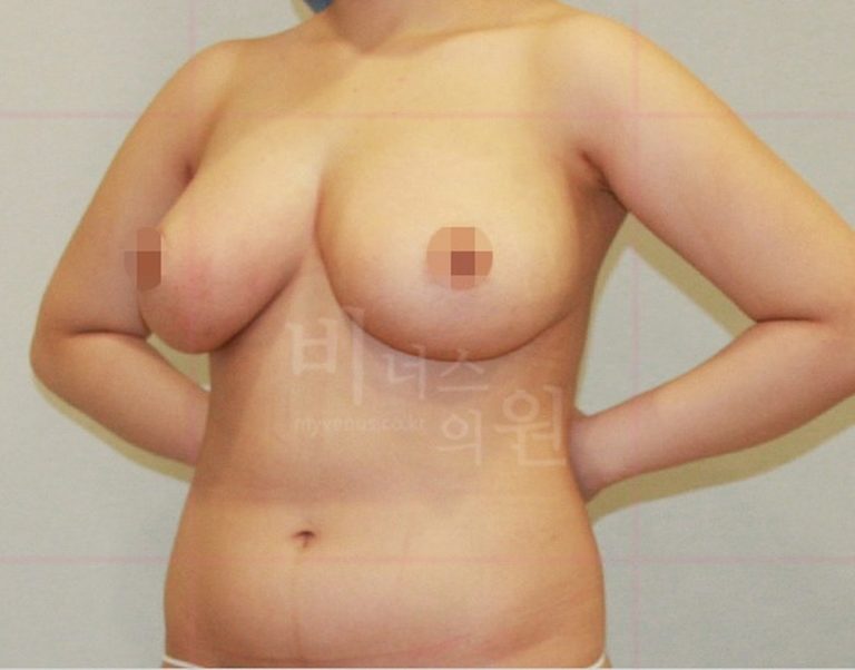 가슴축소 지방흡입, 나한테 맞는 방법인지 확인하는 선택 가이드