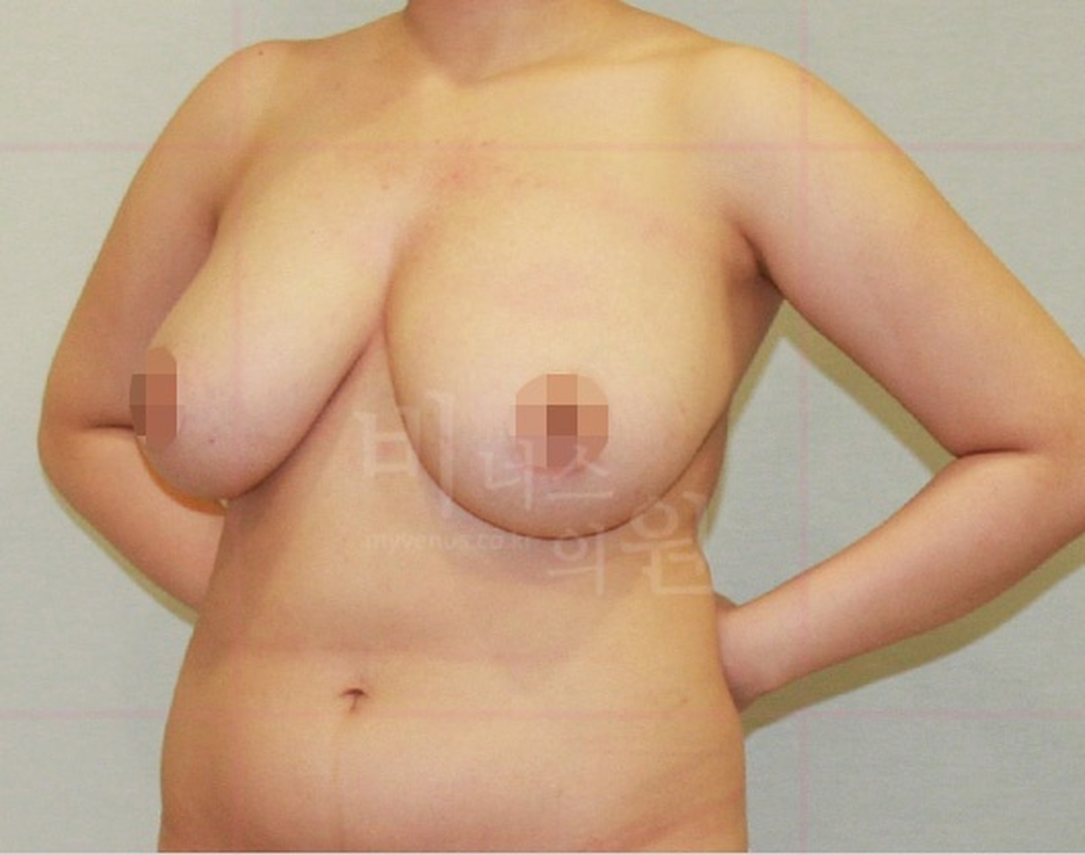 가슴축소 지방흡입 수술 전 사면