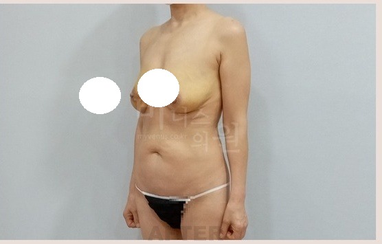 가슴축소 지방흡입 수술 후 2주 좌사면