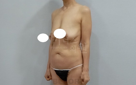 가슴축소 지방흡입 수술 전 좌사면