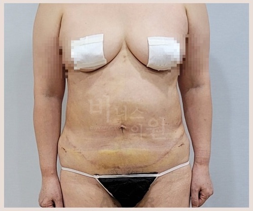 인천지방흡입 상담, 현명하게 준비하는 법 — 질문 리스트부터 견적서 해석까지