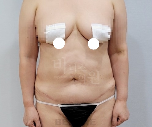 복부 지방흡입 수술 전 정면 차렷 자세