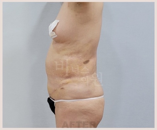 복부 지방흡입 수술 후 1주 우측면