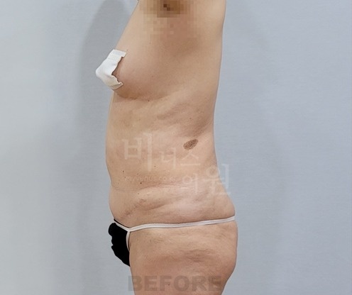 복부 지방흡입 수술 전 우측면
