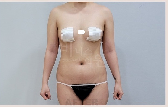 팔뚝 지방흡입 수술 후 1주 정면 차렷 자세