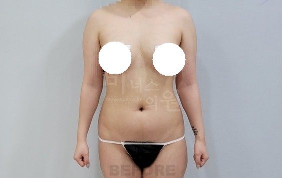 팔뚝 지방흡입 수술 전 정면 차렷 자세