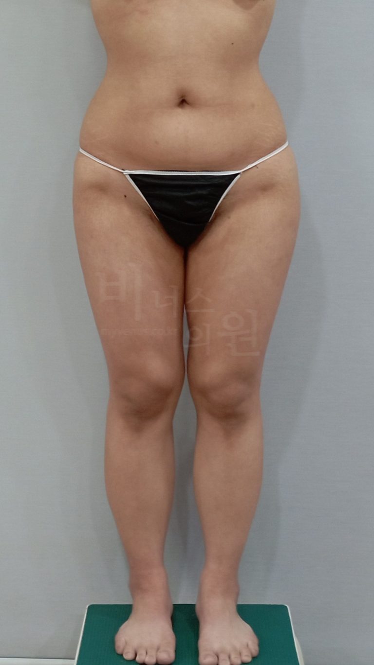 허벅지 안쪽 지방흡입, 솔직하게 알려드릴게요 — 비용·수술 범위·병원 선택 가이드