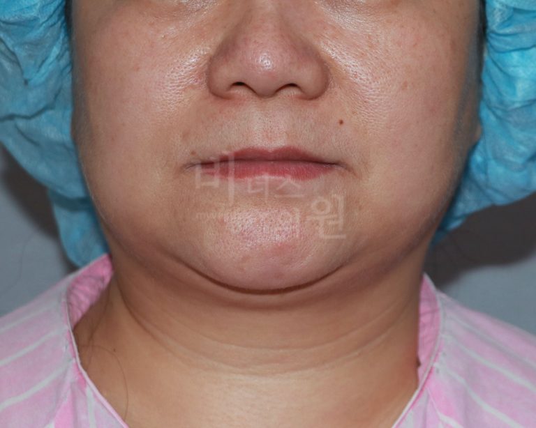 턱지방흡입 비용이 고민이라면? 부위·방법·병원 선택 가이드