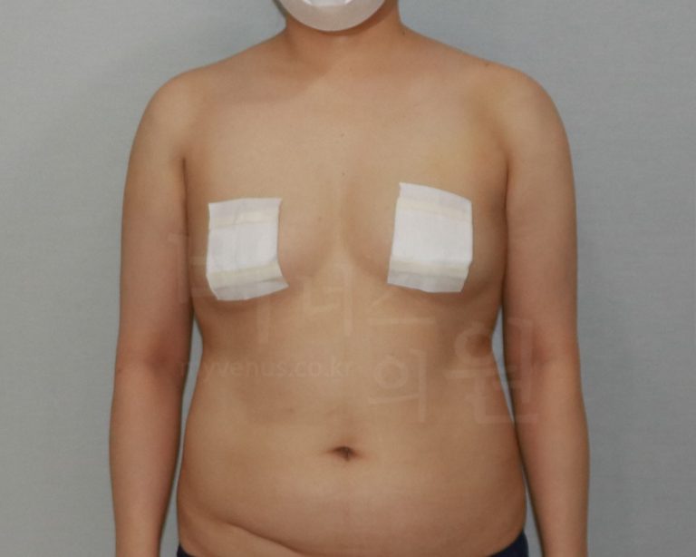 팔뚝지방흡입 대용량 수술이란? 비용·범위·결과 차이 완전 가이드