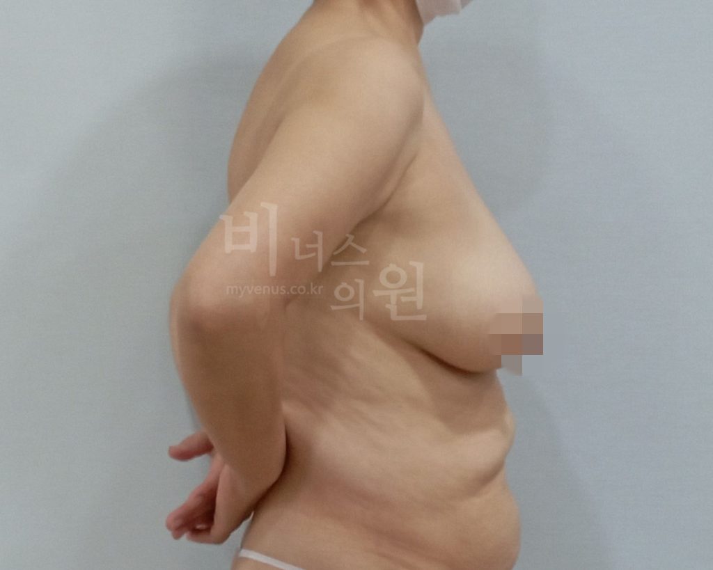 엉덩이지방흡입 수술 전