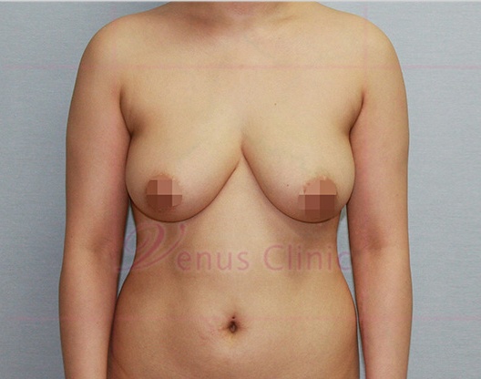 가슴축소 지방흡입 정면 수술 전 — 비너스의원