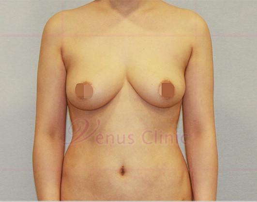 가슴축소 지방흡입 정면 수술 후 — 비너스의원